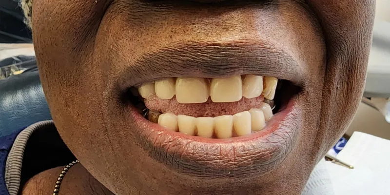 Teeth after treatment