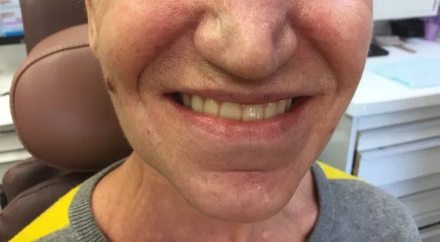 Teeth after treatment
